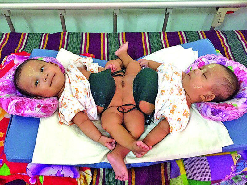 The conjoined twins being seen at Mandalay Children Hospital. 