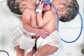 Central Women’s Hospital Mandalay successfully operates conjoined male twins